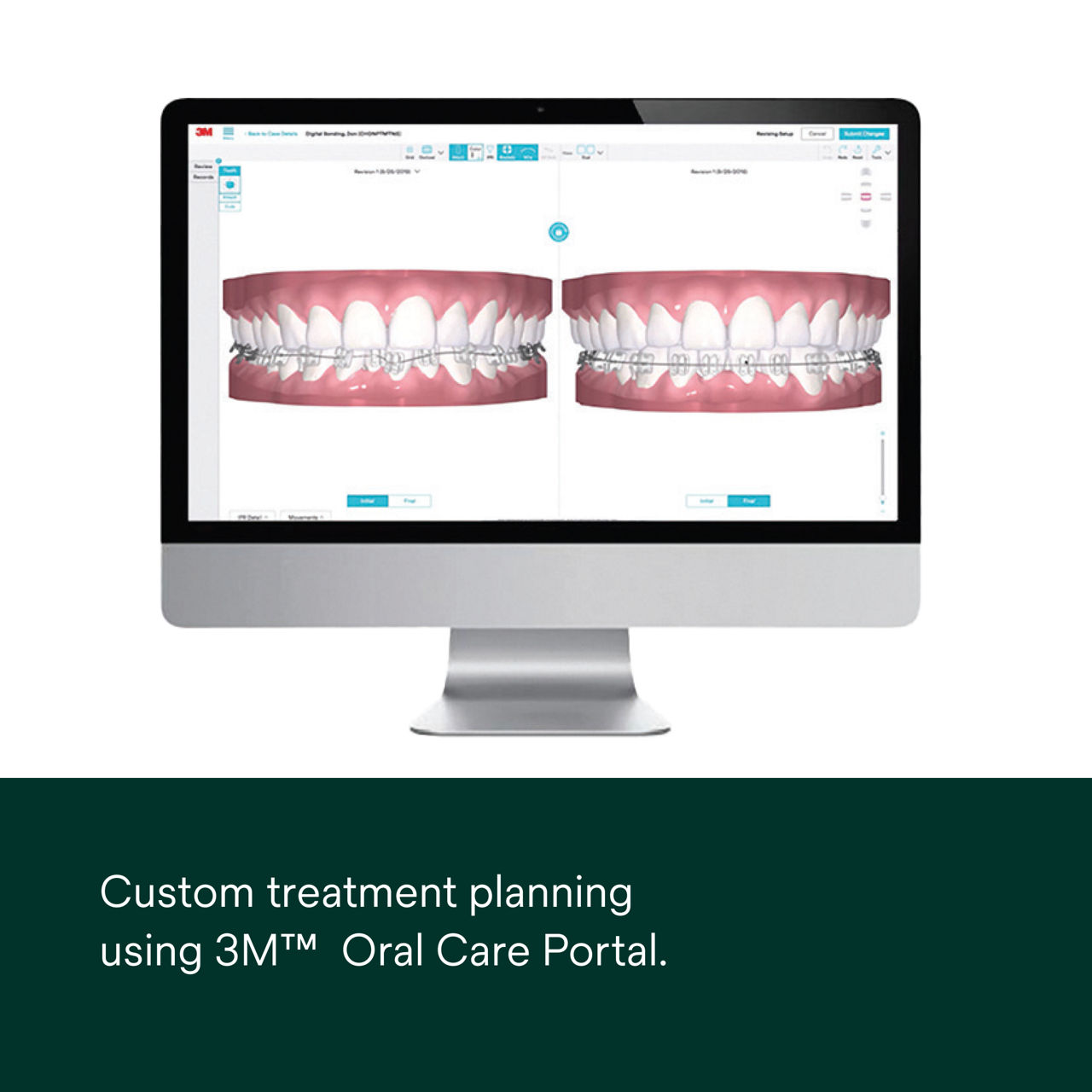 3 - Digital Bonding Tray: Custom treatment planning