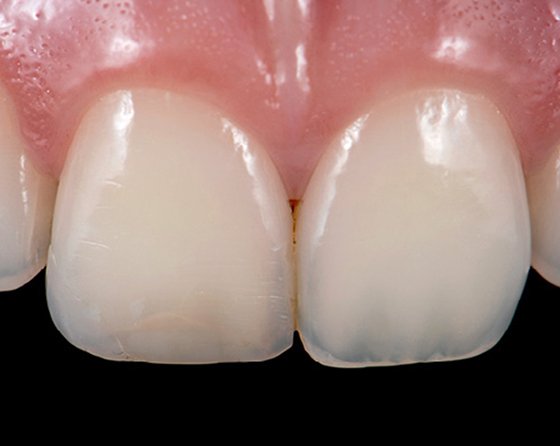 Small discoloration is seen along with uneven incisal edges