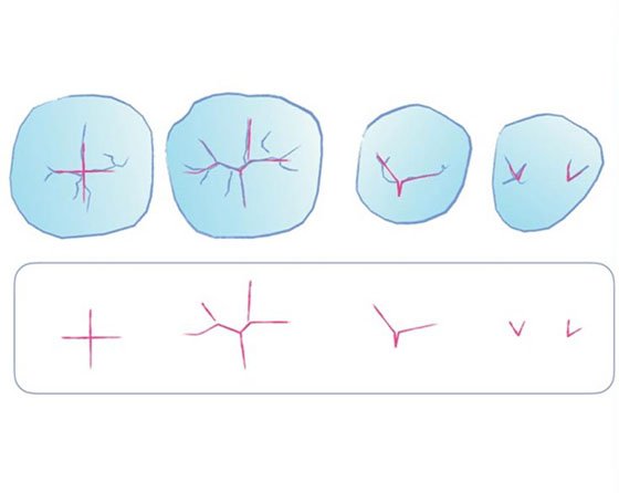 Drawing of essential lines found in mandibular premolars and molars