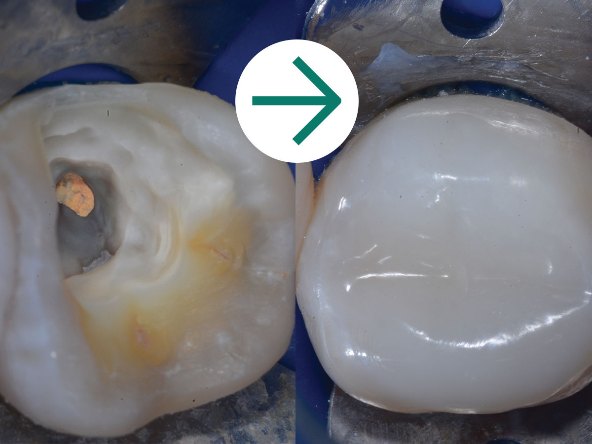 3M™ Filtek™ Bulk Fill Flowable Syringe: Case Study Before & After - Injection Over-Molding