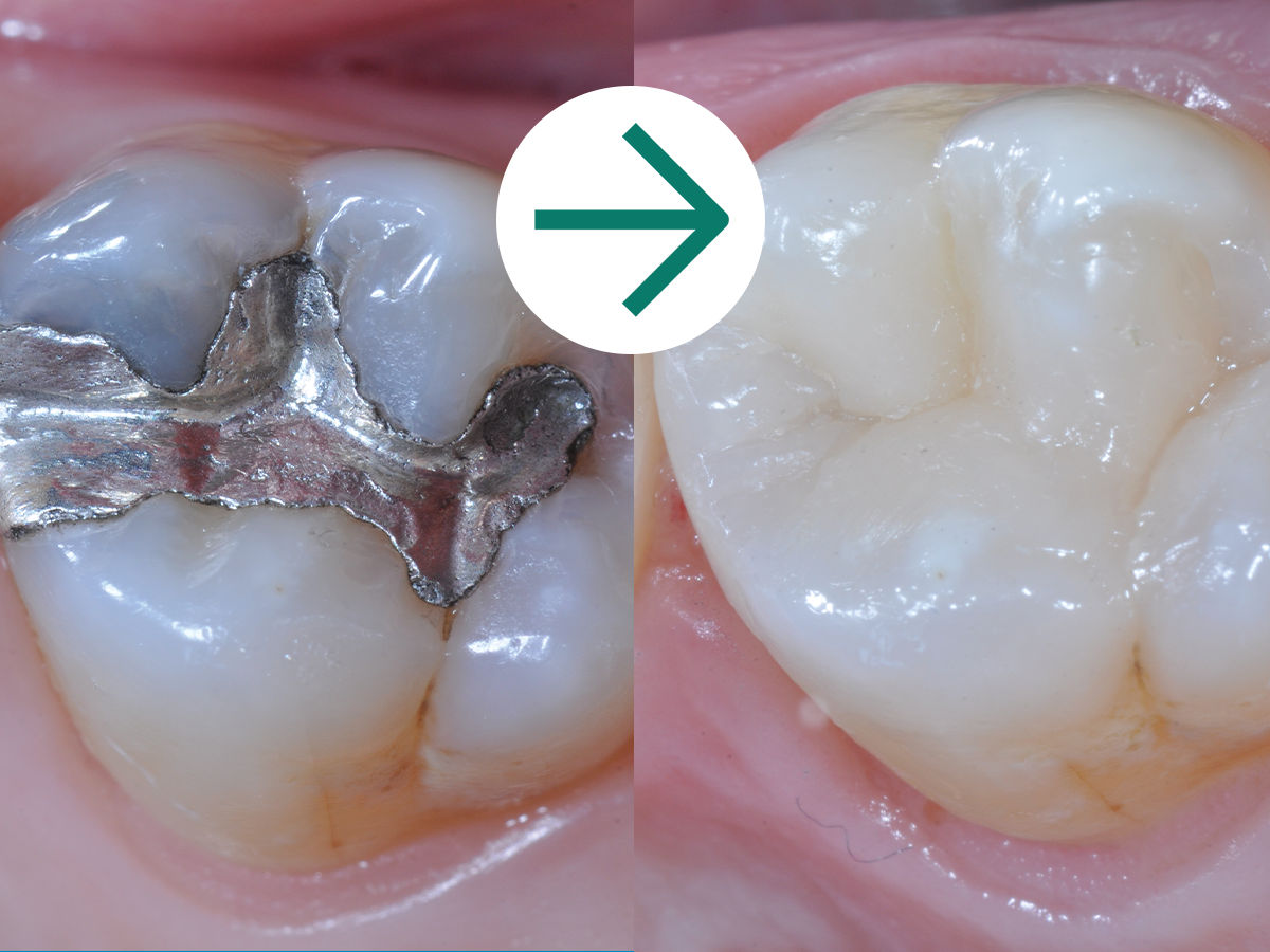 3M™ Filtek™ One Bulk Fill: Case Study Before & After - Direct Restoration