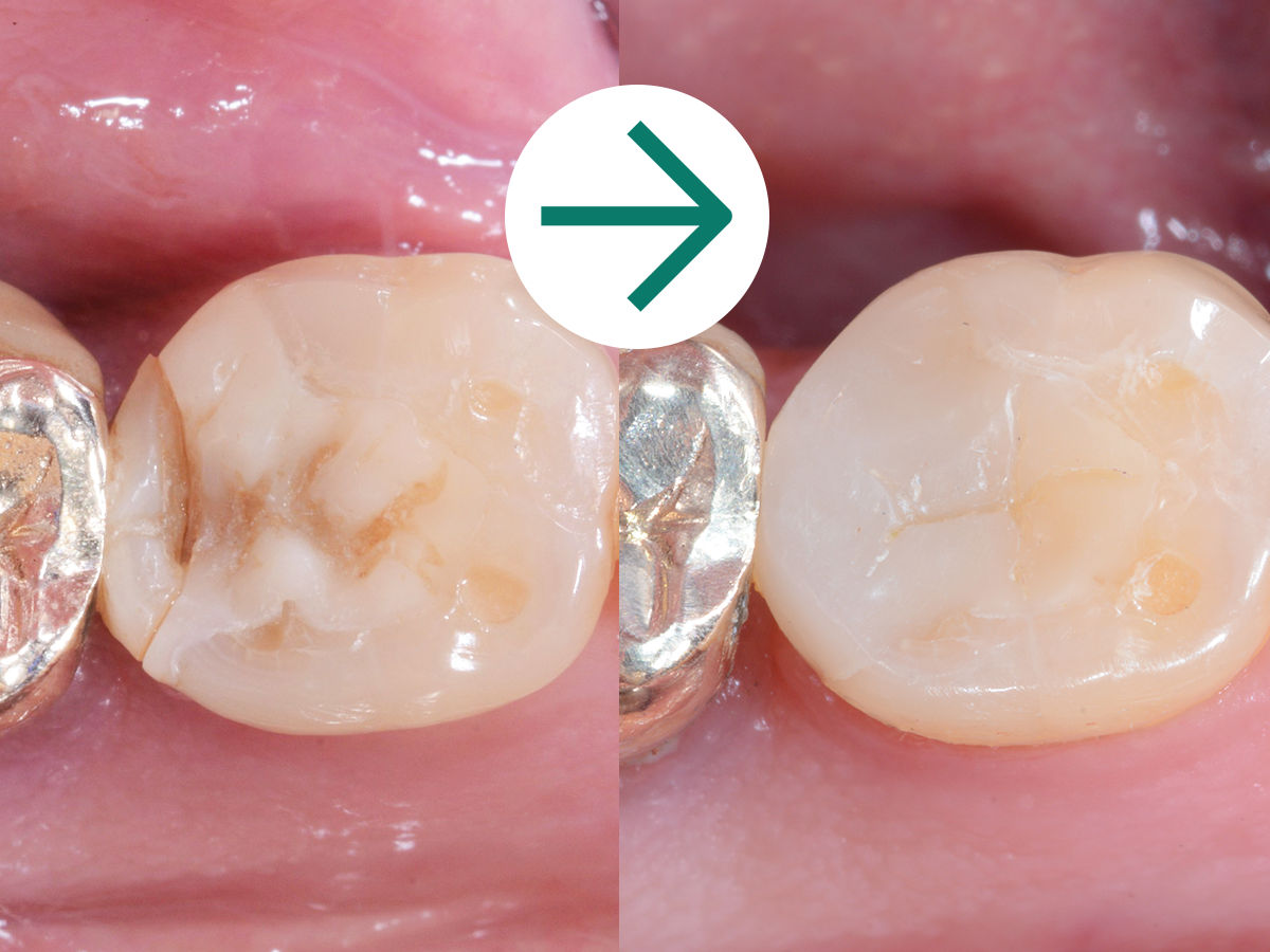 3M™ Filtek™ One Bulk Fill: Case Study Before & After - Treatment of Fractured Composite Restoration