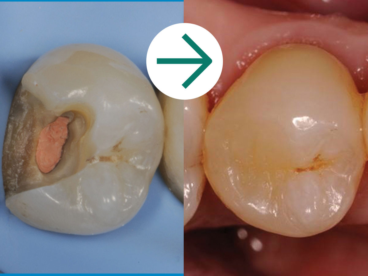 3M™ Filtek™ One Bulk Fill: Case Study Before & After - Treatment of Deep Carious Lesion