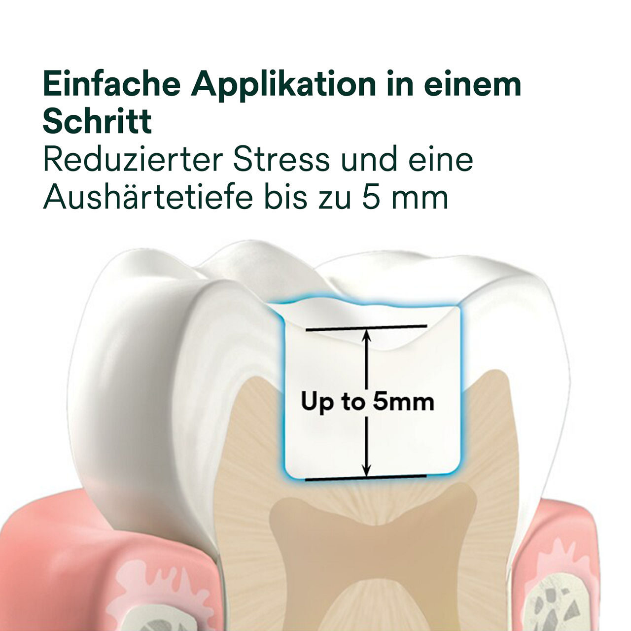 2- Filtek One Bulk Fill: Einfache Applikation in einem Schritt