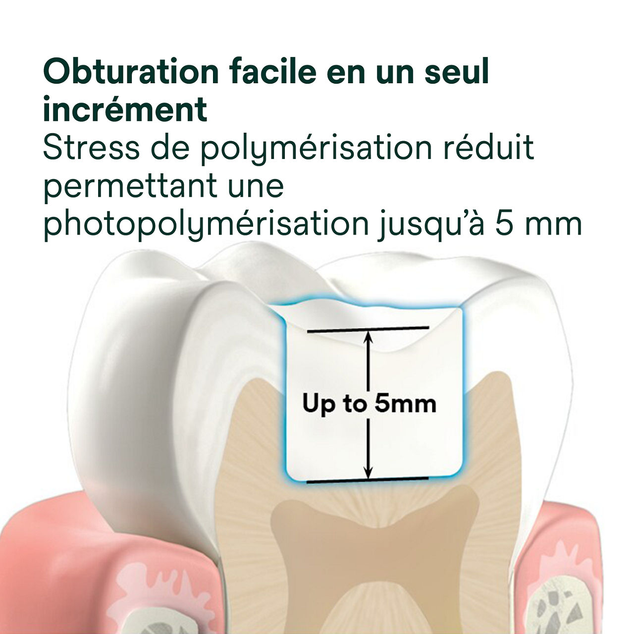 2- Filtek™ One Bulk Fill: Obturation facile en un seul incrément –