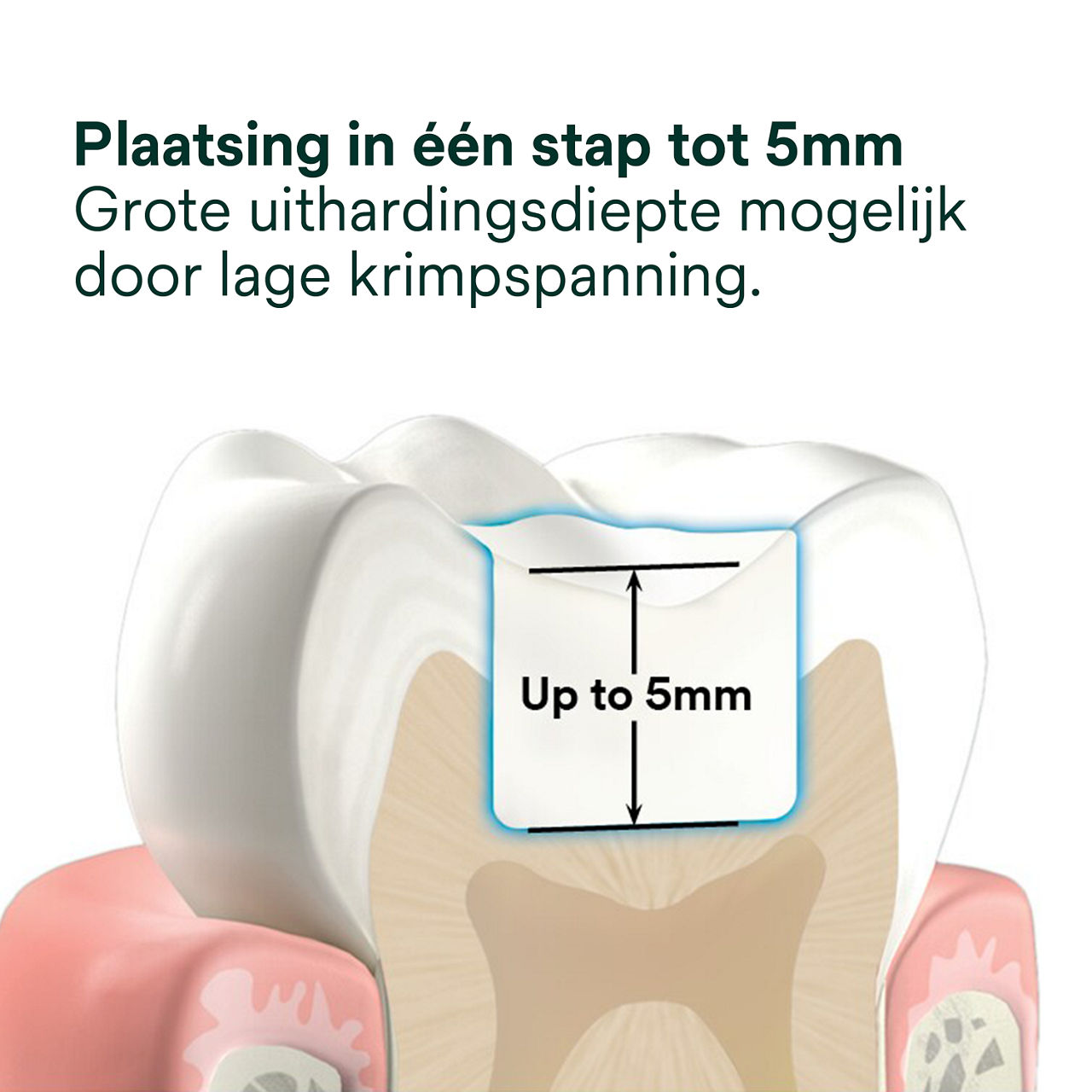 2- Filtek One Bulk Fill: Plaatsing in één stap tot 5mm