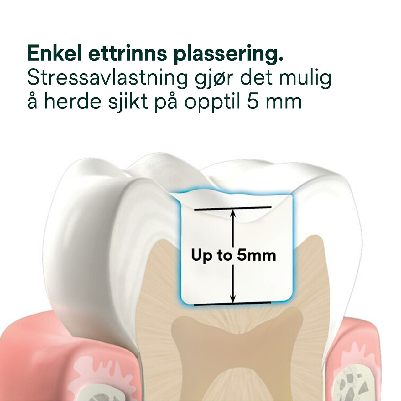 2- Filtek™ One Bulk Fill: Enkel ettrinns plassering