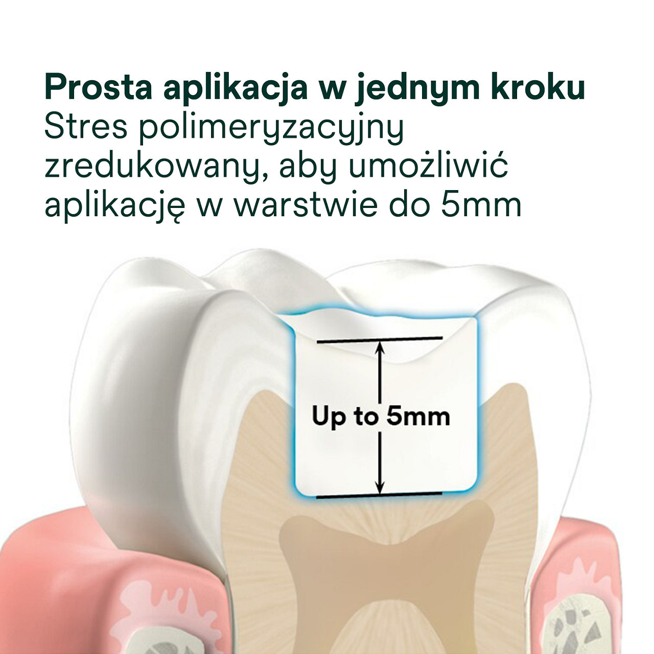 2- Filtek One Bulk Fill: Prosta aplikacja w jednym kroku