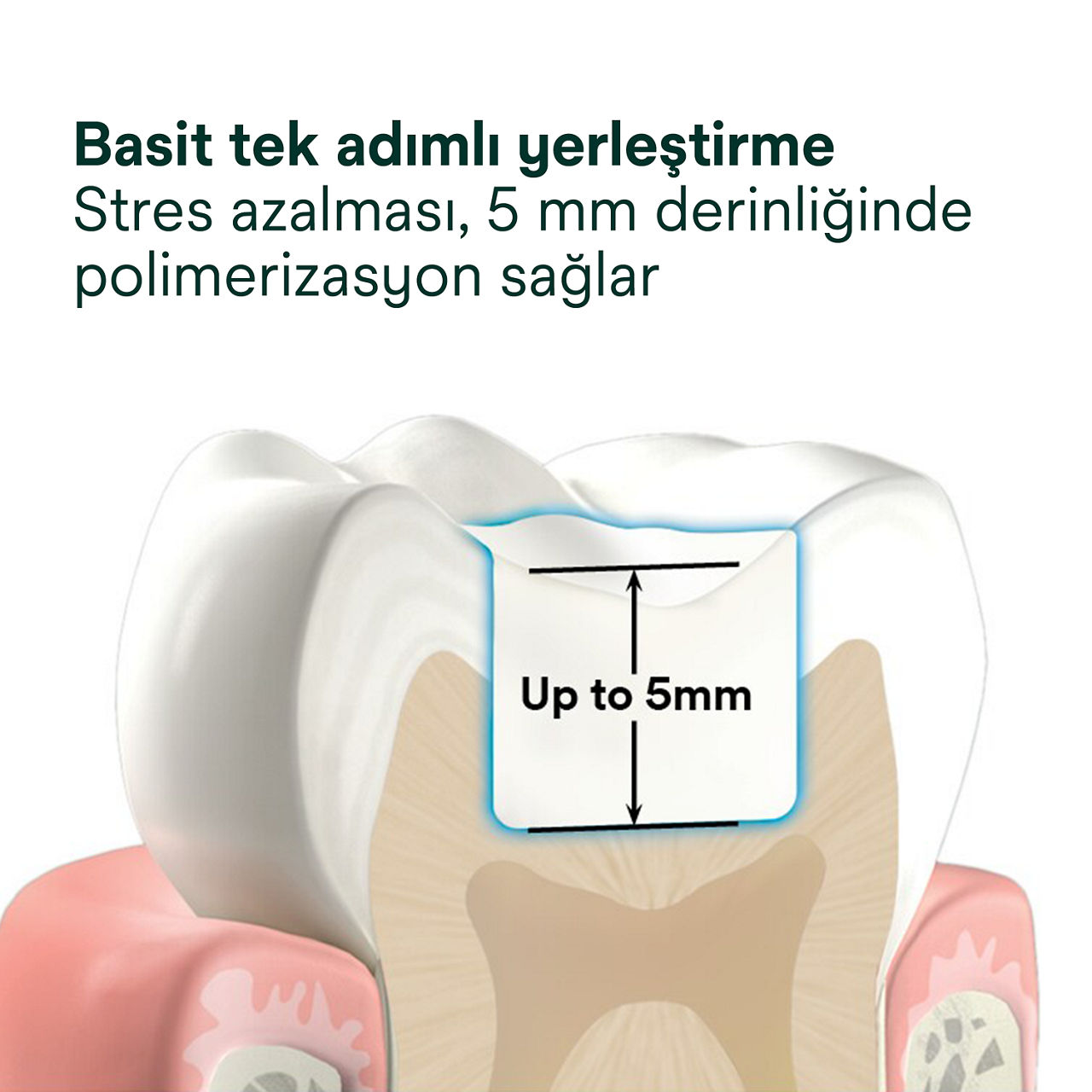 2- Filtek One Bulk Fill: Basit tek adımlı yerleştirme