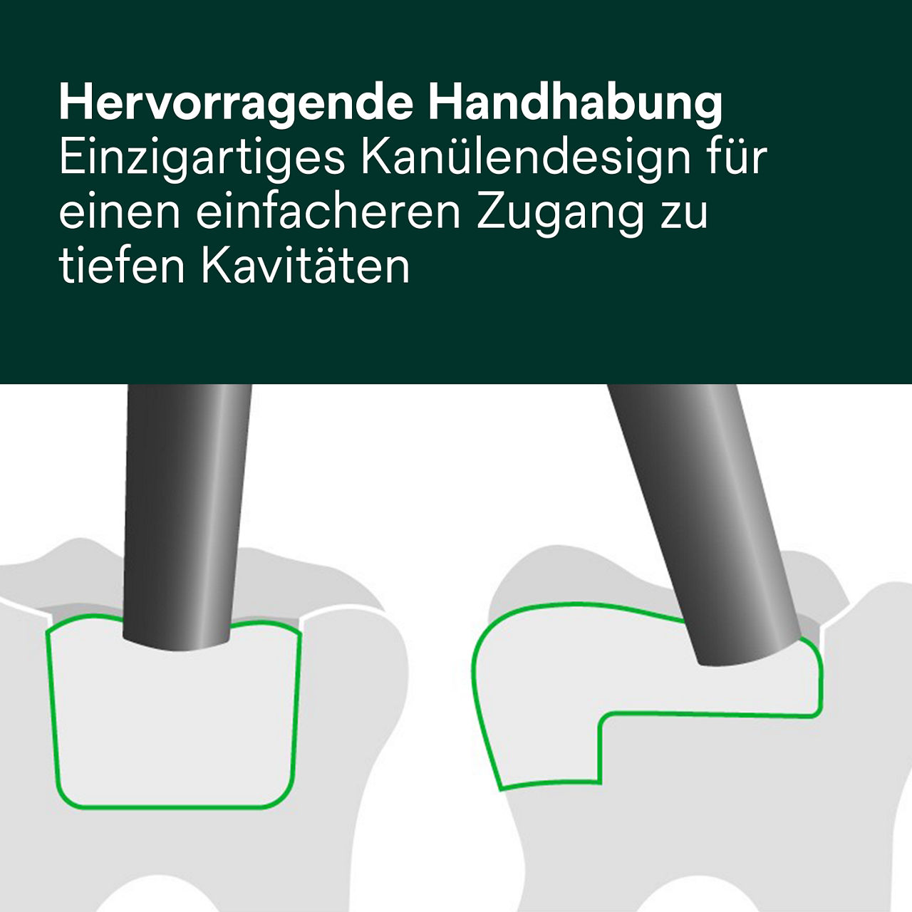 4- Filtek One Bulk Fill: Hervorragende Handhabung