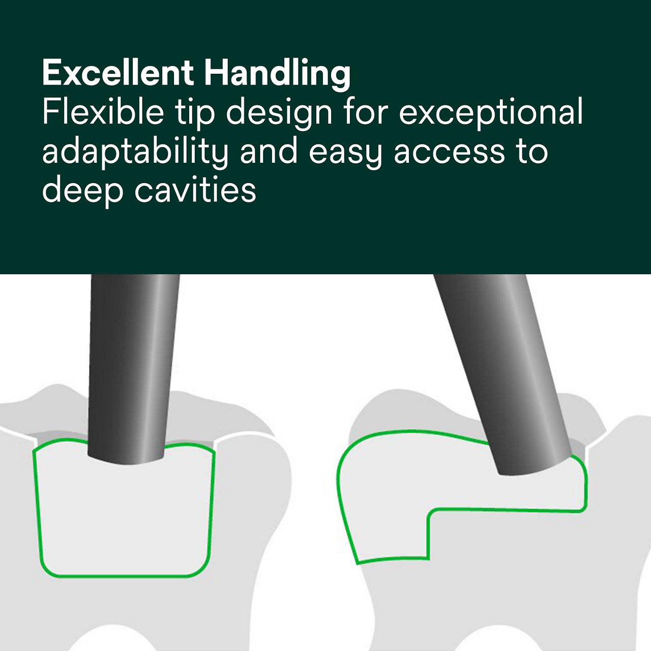 (4) 3M™ Filtek™ One Bulk Fill: Excellent Handling