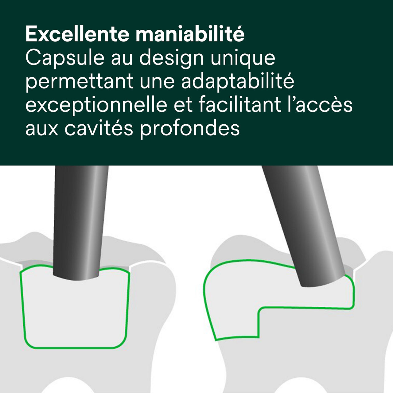 4- Filtek™ One Bulk Fill: Excellente maniabilité