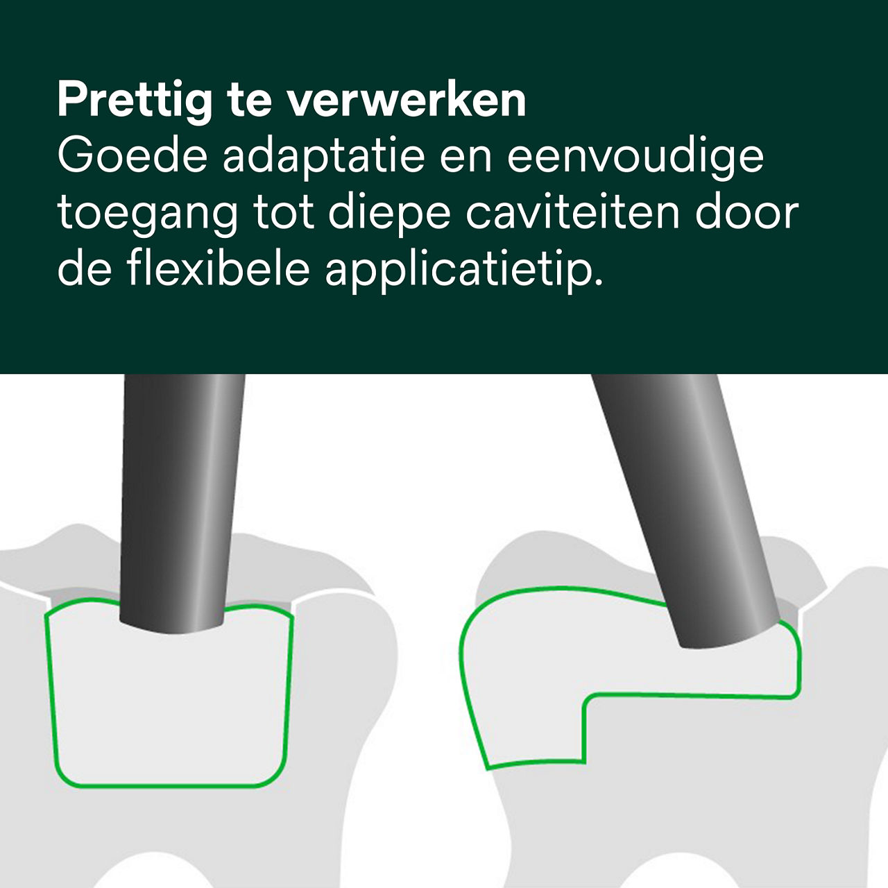 4- Filtek One Bulk Fill: Prettig te verwerken