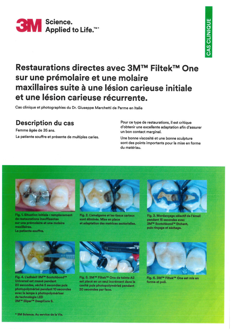 Cas Clinique 3M™ Filtek™ One premolaire et molaire