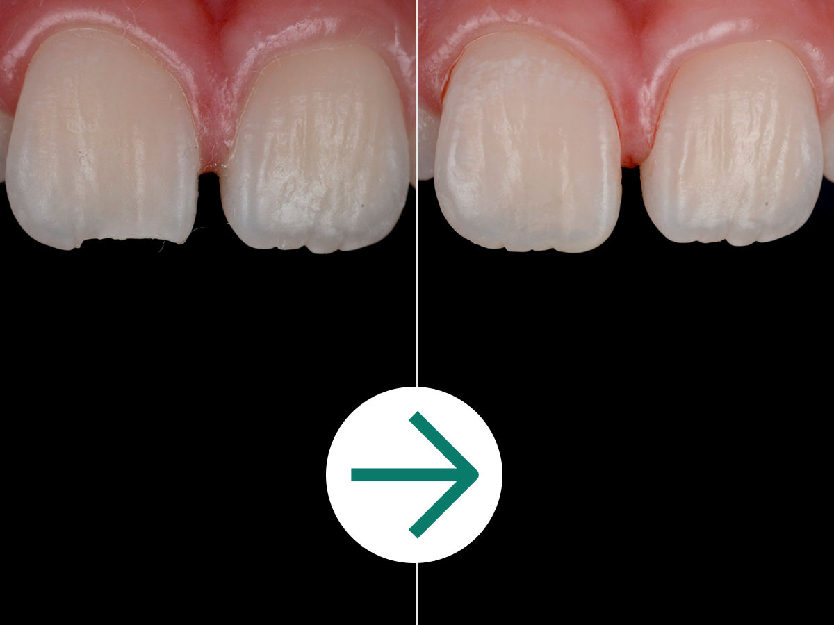 Filtek Supreme Flowable, Syringe: A+ Module 3.1 - Clinical Case Before & After - Enamel Chipping