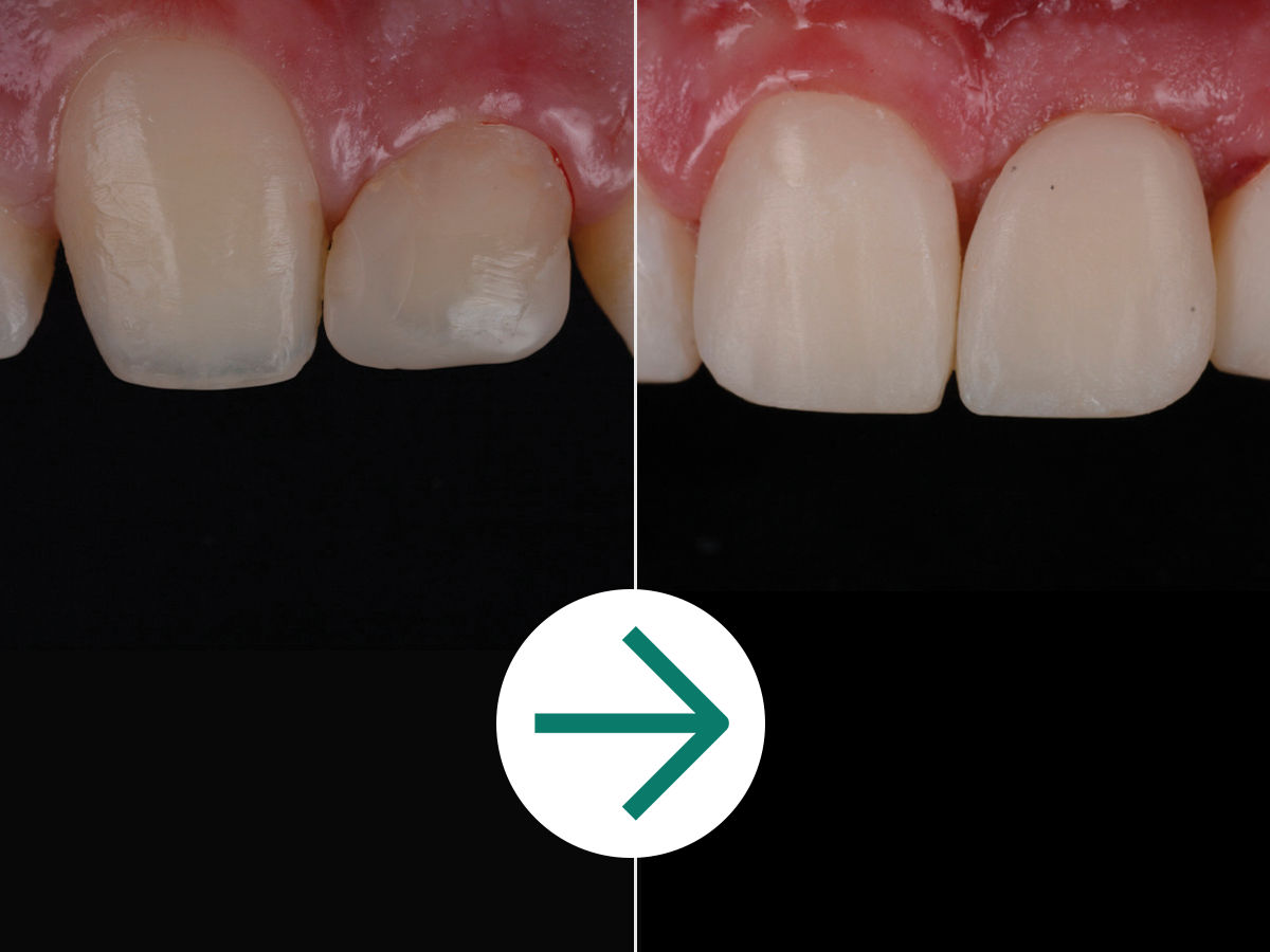 Filtek Supreme Flowable, Syringe: A+ Module 3.2 - Clinical Case Before & After - Single Shade