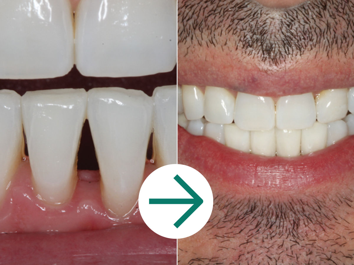 Filtek Supreme Flowable, Syringe: A+ Module 3.3 - Clinical Case Before & After - Black Triangles