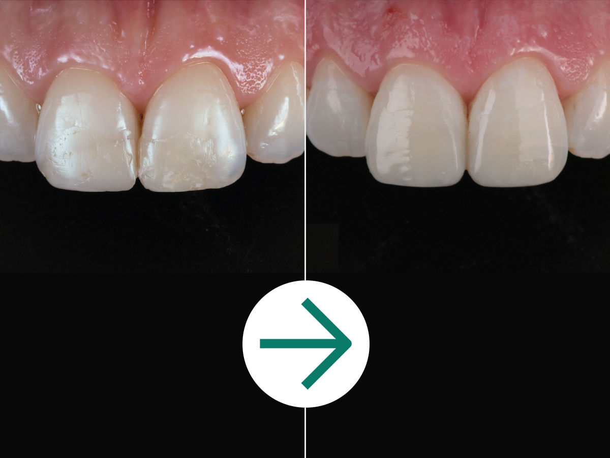 PDP Case Study Before & After: Anterior Esthetic Techniques