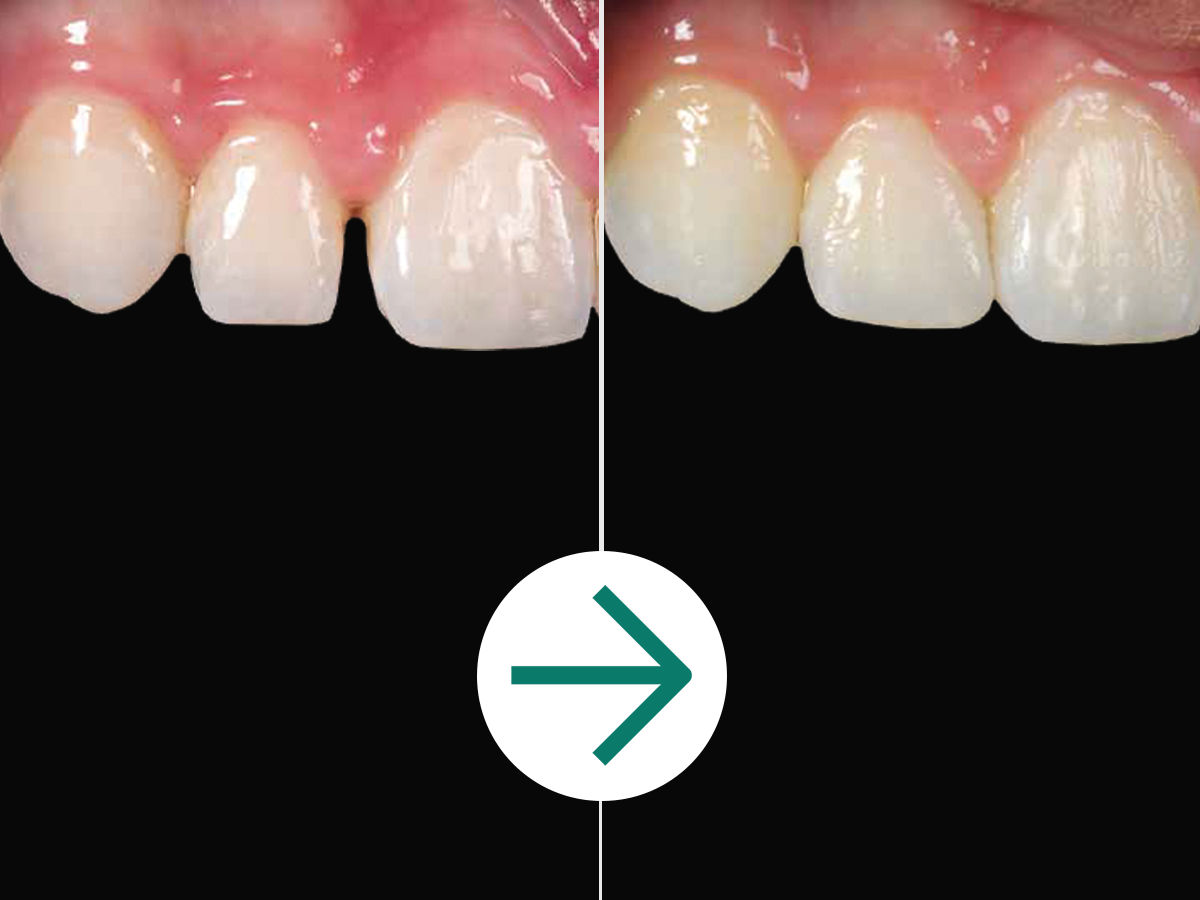 PD Case Study Before & AfteR: Lateral Diastema Closure