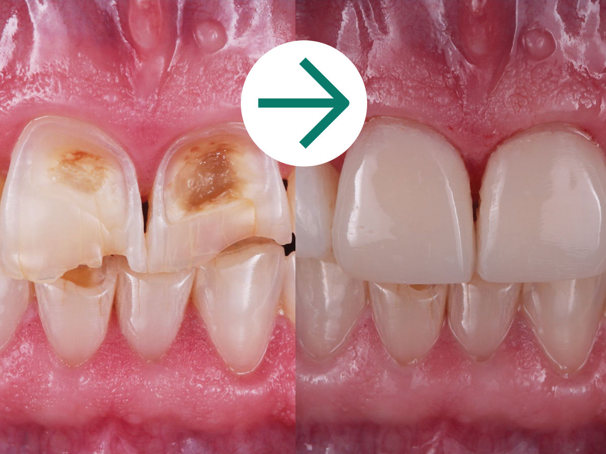 Clinical Case - Filtek Universal: Before & After Pink Opaquer