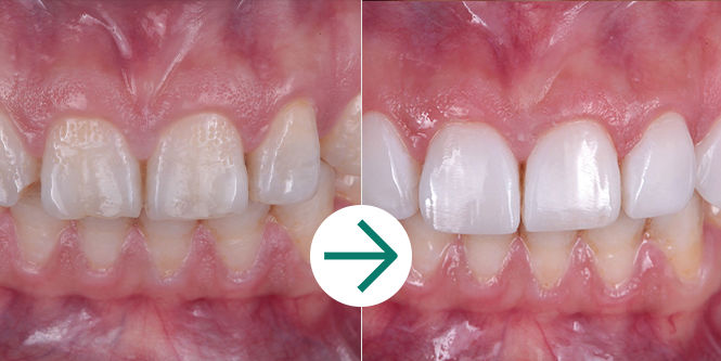 Clinical Case - Filtek Universal: Before & After Extra White