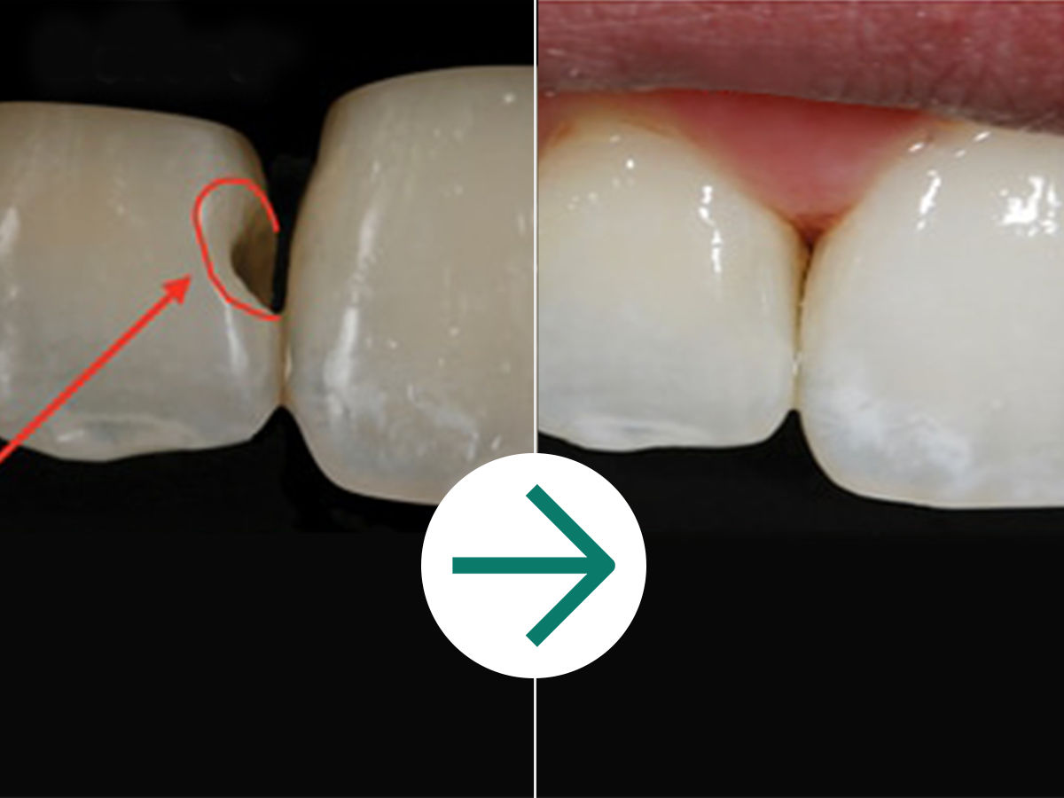 Clinical Case - Filtek Universal: Before & After Bioclear Matrix