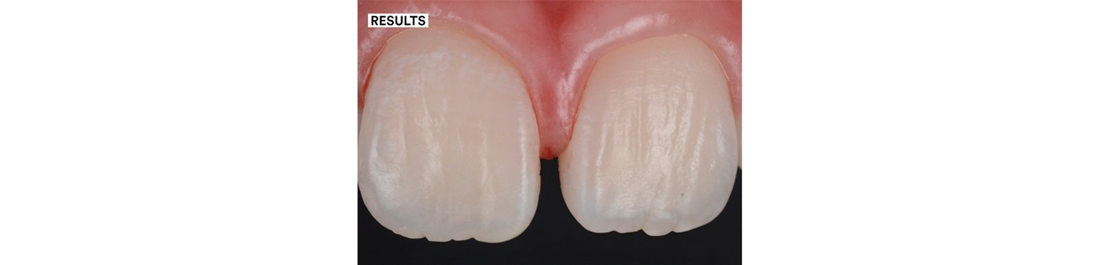 Final esthetic result