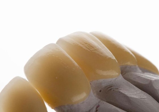 Final restorations with esthetic zirconia crowns