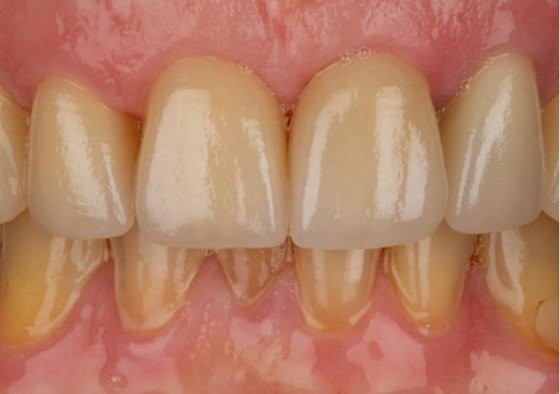 Results of zirconia restorations