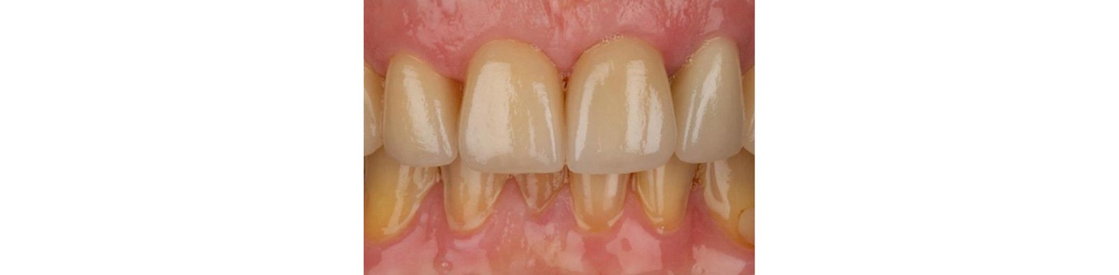 Results of zirconia restorations