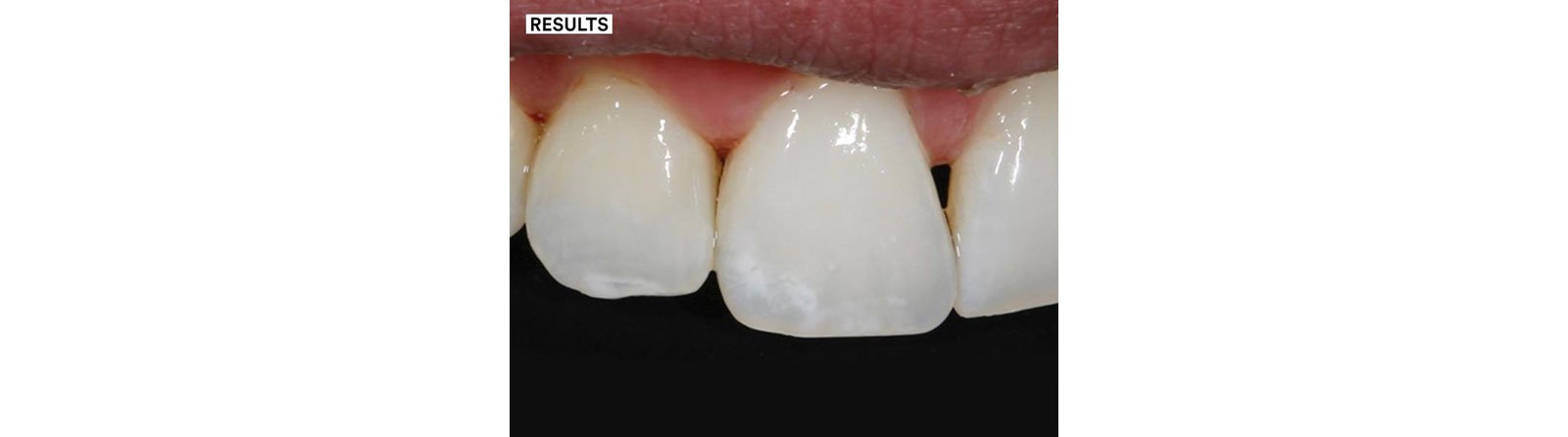 Final results of restoration