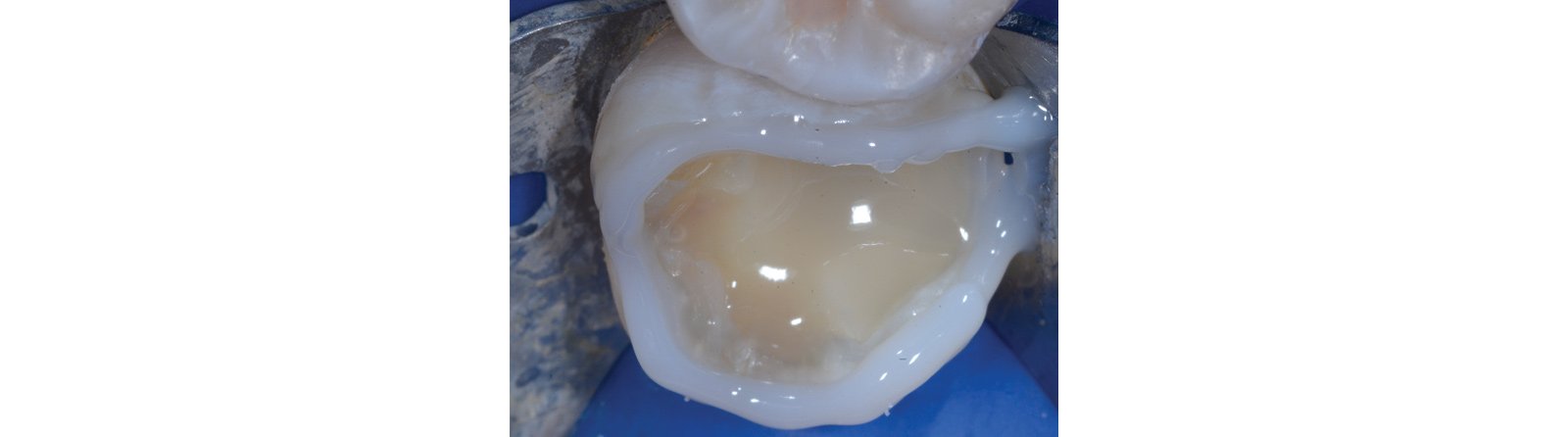 A flowable composite "curb" is placed and light cured to improve management of the injection phase