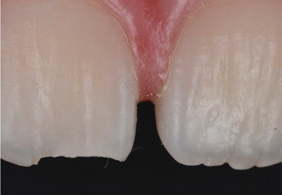 Fractured upper-right central incisor