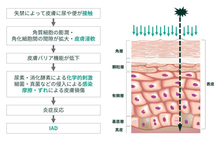 IADは、失禁のある患者で、尿や便が皮膚に直接触れ続けていることで皮膚が浸軟したところに、摩擦やずれ、化学的刺激、あるいは感染が加わって発生します。
