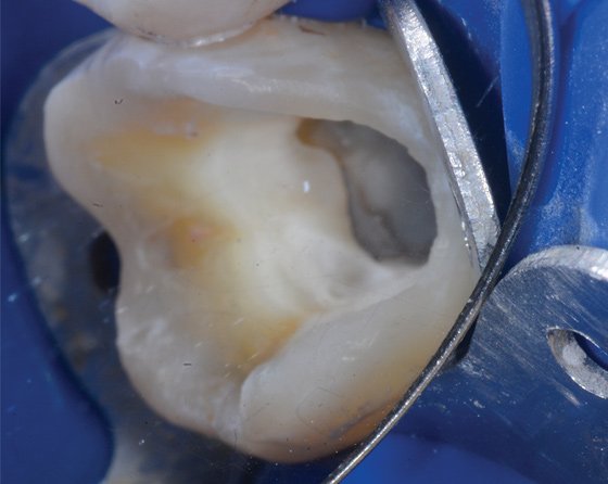 Lateral cuspal overlay preparation protects the buccal cusps