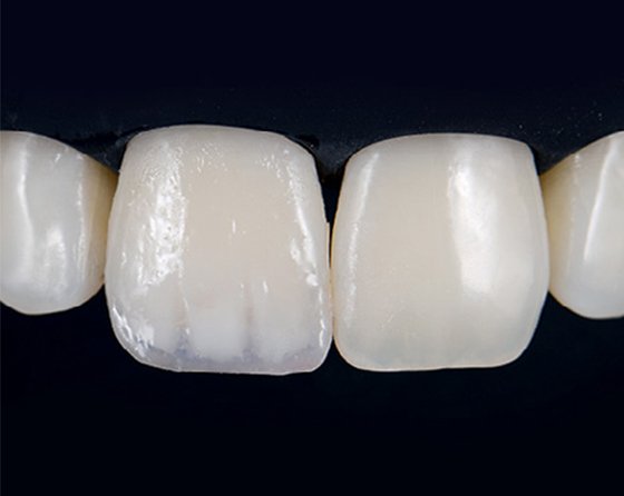 A layer of composite is the foundation for a uniform final enamel layer