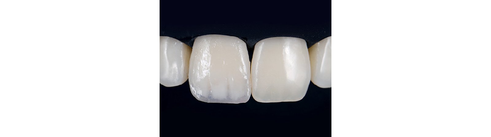 A layer of composite is the foundation for a uniform final enamel layer