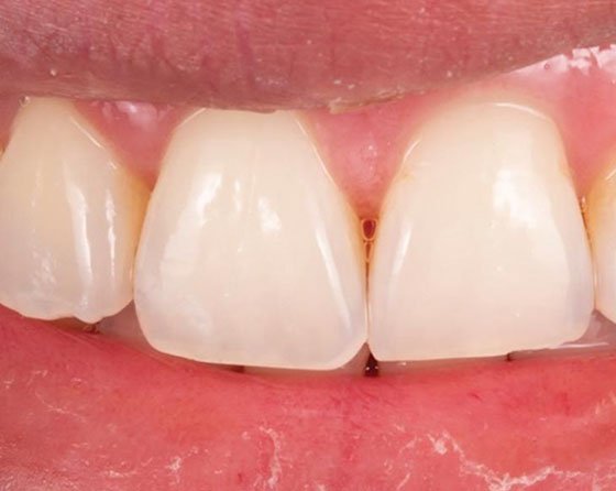 Lesion on tooth No. 7