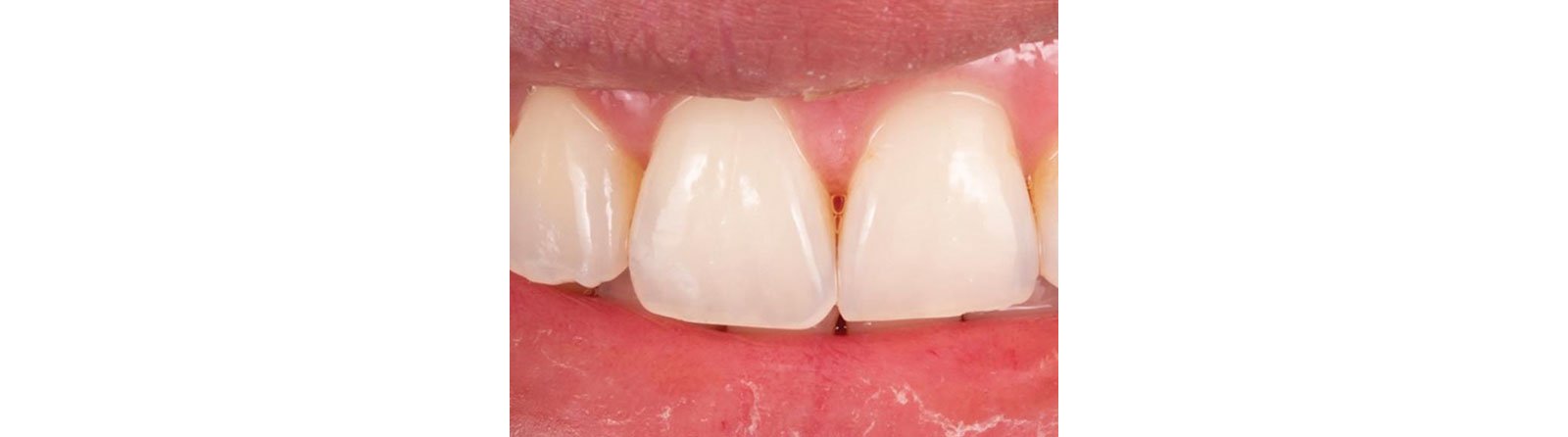 Lesion on tooth No. 7