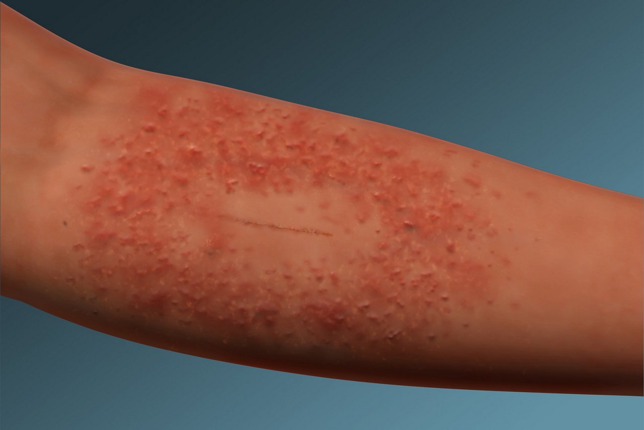 Lésions cutanées liées aux adhésifs médicaux Dermatite allergique
