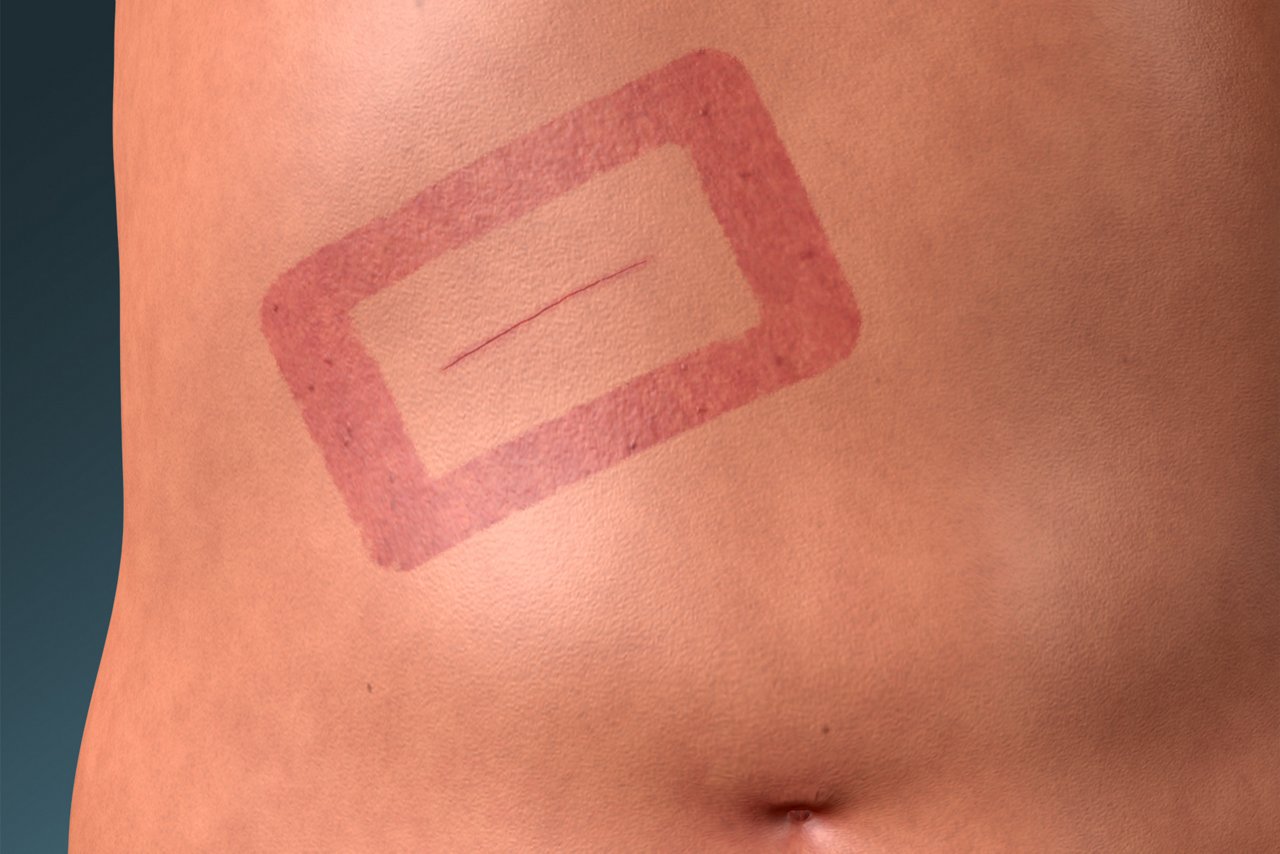 MARSI Contact Dermatitis