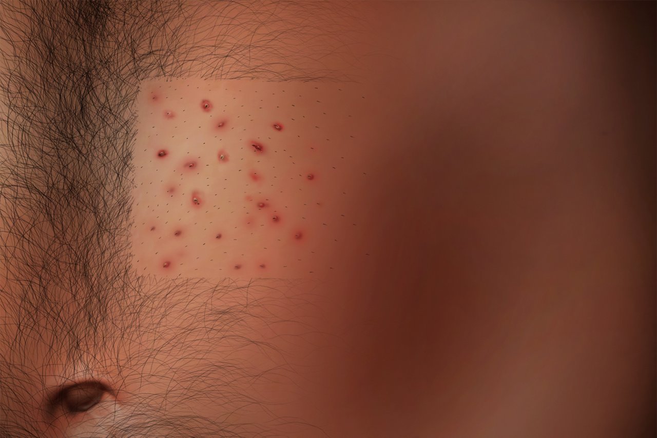 Lésions cutanées liées aux adhésifs médicaux Folliculite