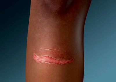 Illustratie van een huidtrauma, MARSI, technische illustratie