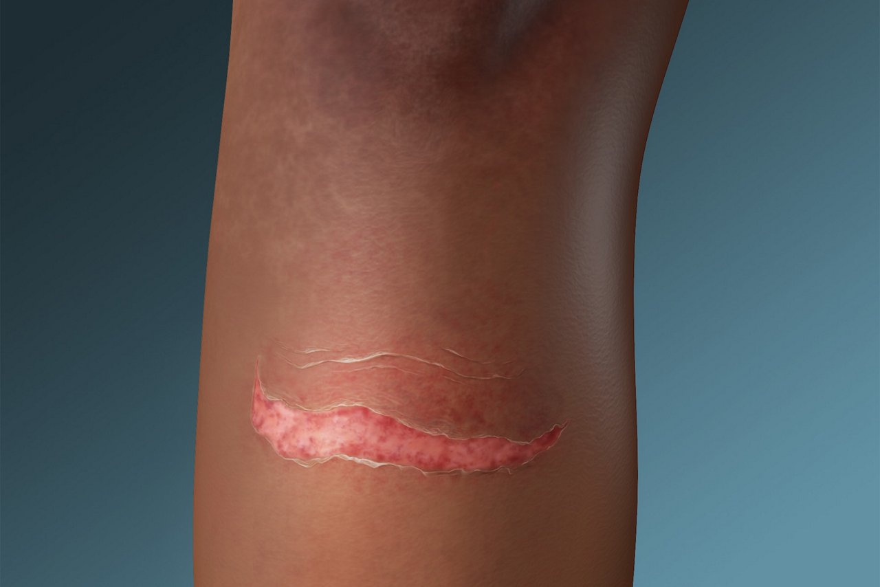 Lésions cutanées liées aux adhésifs médicaux Déchirure cutanée