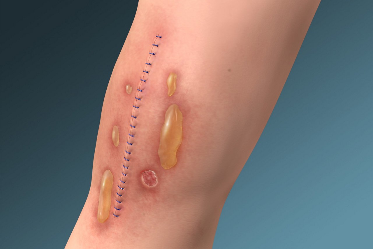 MARSI Tension Injury