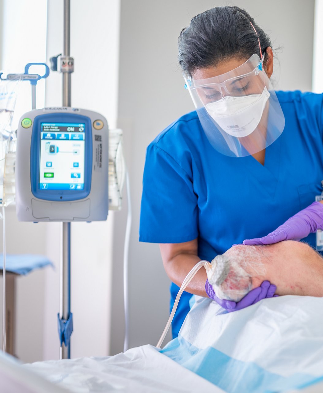 Paziente in ospedale con personale infermieristico che si prepara e applica la terapia VAC per un caso di amputazione; foto 8