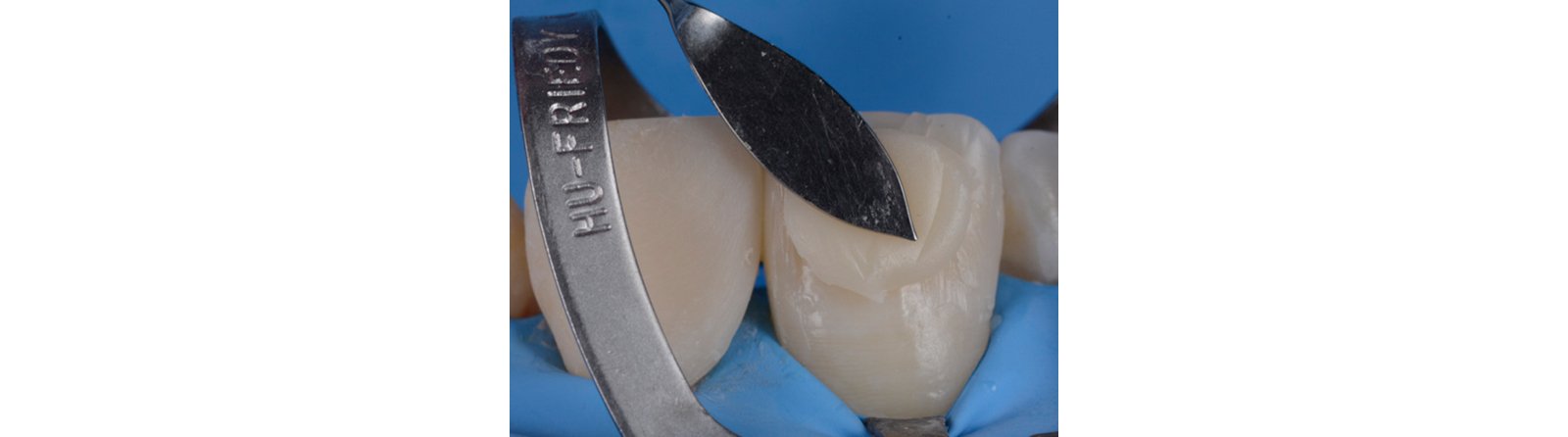 Modeled the buccal area