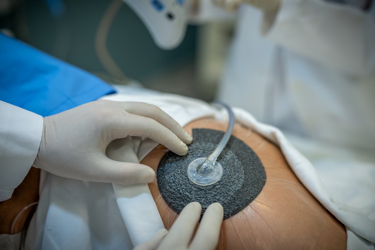 Hip pressure wound with 3M™  V.A.C.® Simplace™ Dressing and 3M™ V.A.C.® Drape, rgb, tif