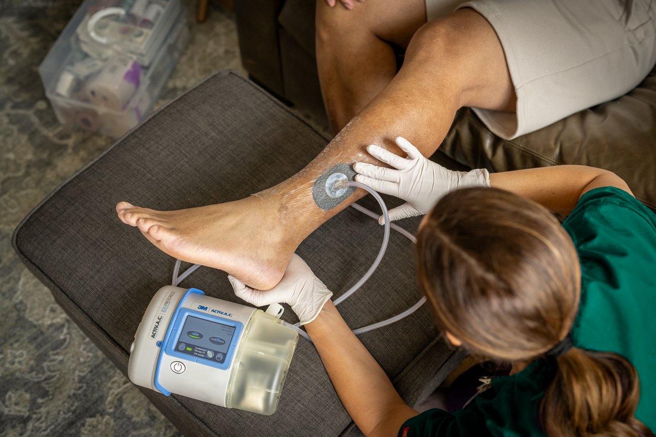 Imagen de belleza de la pierna inferior del paciente con enfermera de atención médica. El paciente lleva el apósito de pelar y colocar 3M™ V.A.C.® y la unidad de terapia 3M™ ActiV.A.C.™. Incluye la almohadilla 3M™ SensaT.R.A.C.™. Marca de Solventum, imagen de aplicación de producto, rgb, tif