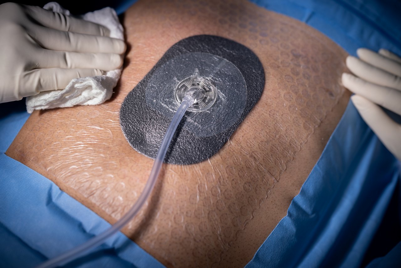 Imagen del torso de un paciente en el quirófano con el apósito 3M™ V.A.C.® Peel and Place aplicado. La imagen incluye la almohadilla 3M™ SensaT.R.A.C.™.